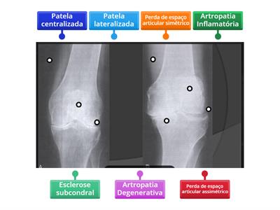 Artropatias