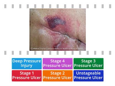 Pressure Ulcer Pictures
