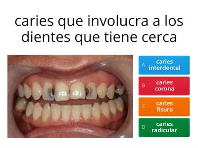 caries