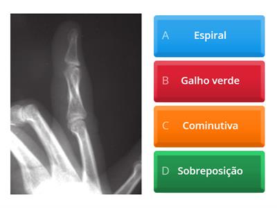 Fraturas em RX