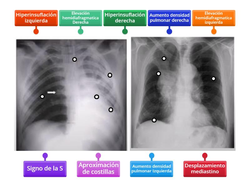 Atelectasias - Labelled diagram