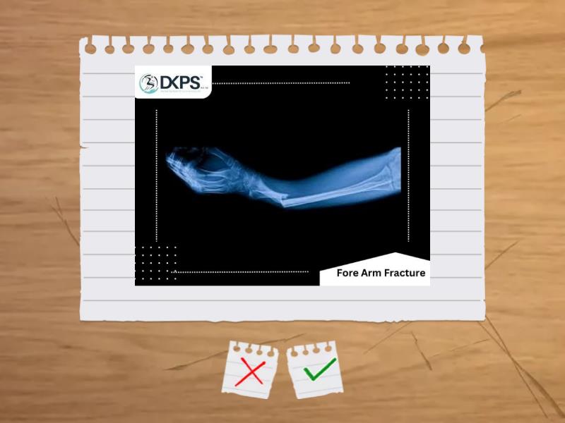 Sports Injuries - Flash cards