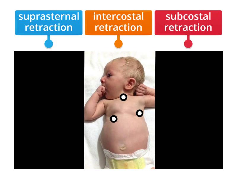 chest retractions - Labelled diagram