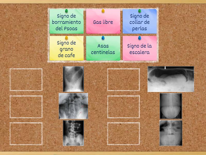 Signos de Rx de abdomen - Match up