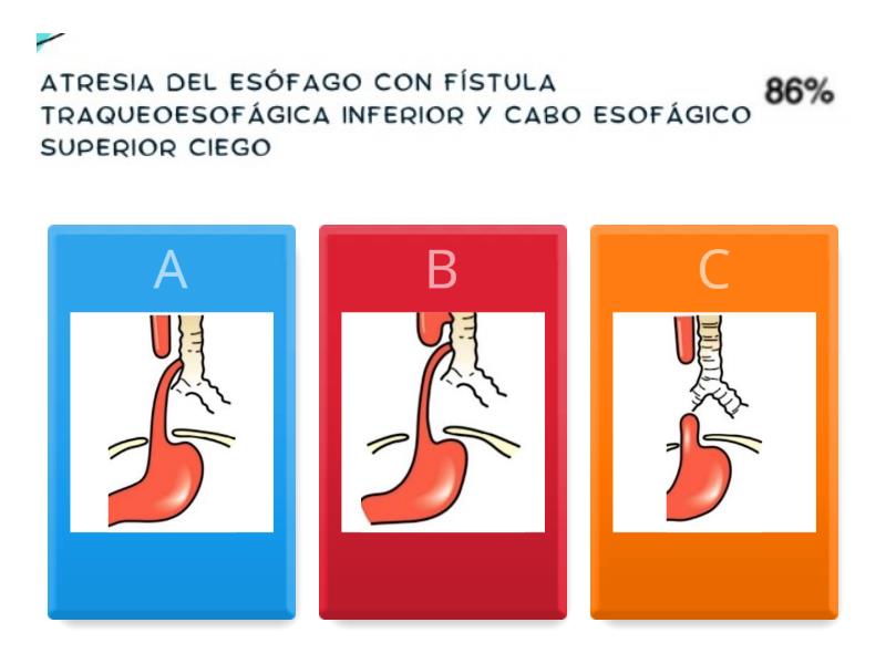 Atresia de Esofago II - Quiz