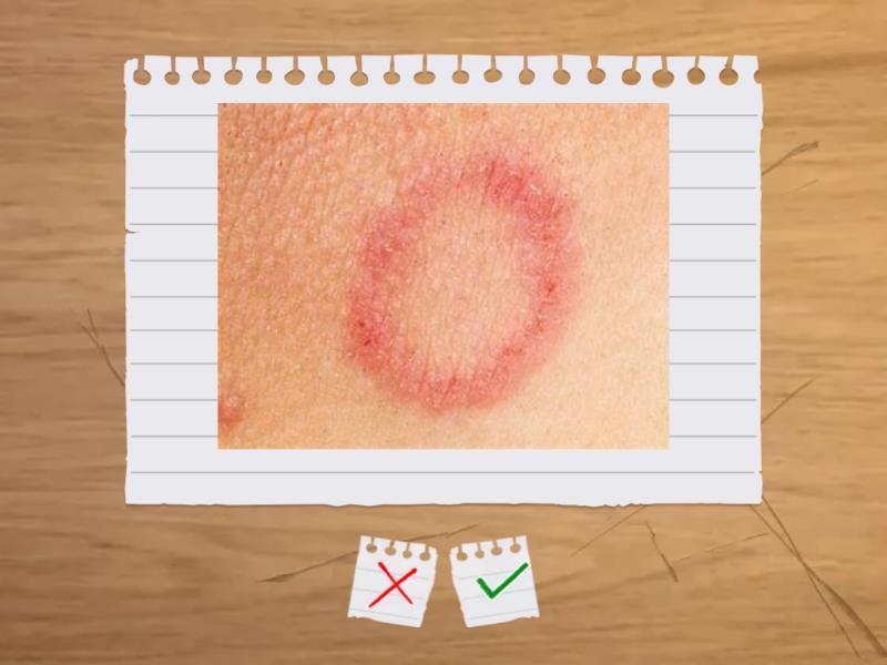 Hand, Foot & Nail Contraindications Flash cards