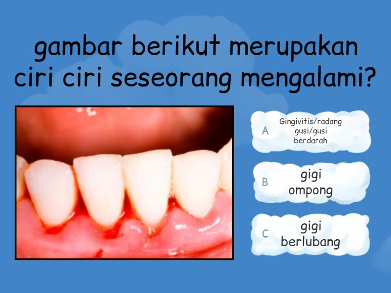 Gingivitis Quiz