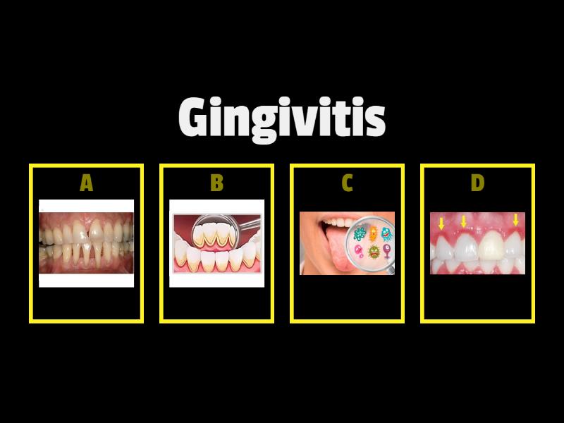 GINGIVITIS Quiz