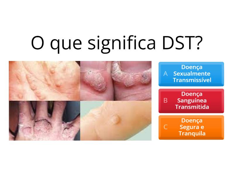 Doenças Sexualmente Transmissíveis - DST - Quiz
