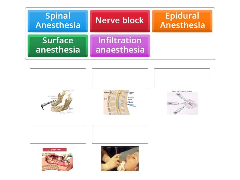 Local Anesthesia - Technique - Match up
